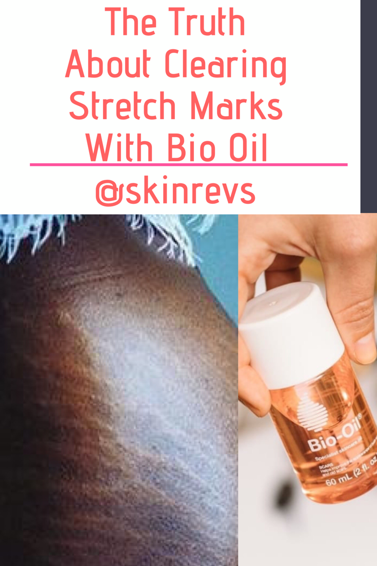 Does Bio oil clear stretch marks ? Here's the Truth : SkinRevs